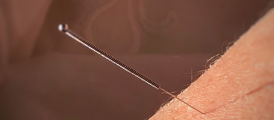 Acupuntura y hemorroides