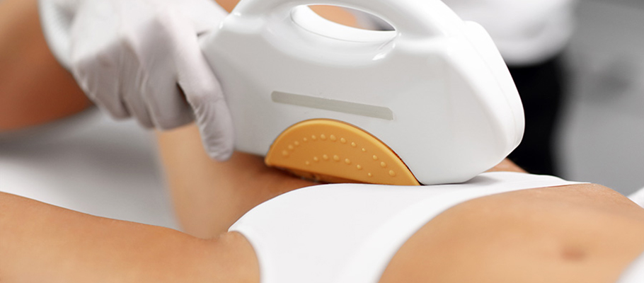 Depilación láser y hemorroides