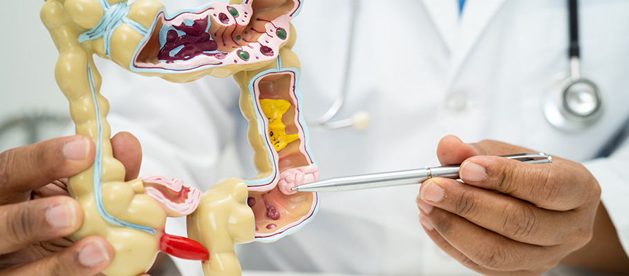 Fisura anal secundaria