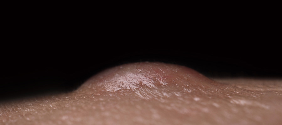 Guía completa sobre el absceso anorrectal