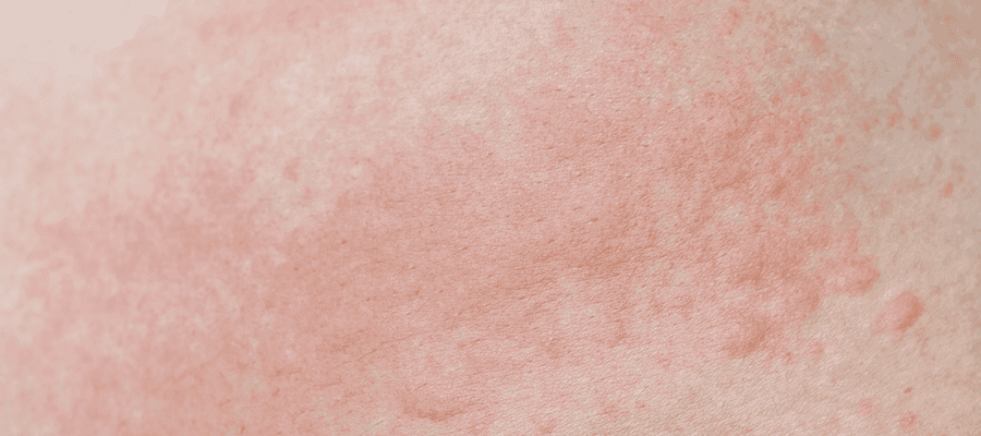 Todo lo que debes saber sobre la dermatitis perianal
