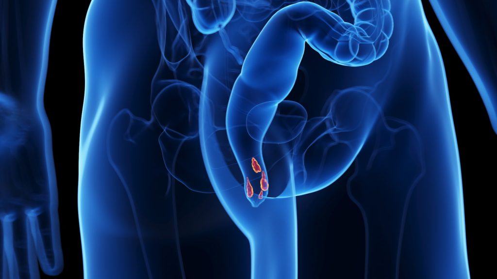 complicaciones-de-las-hemorroides