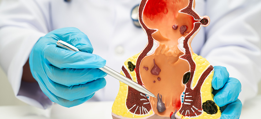 Modelo anatómico de hemorroides internas y externas